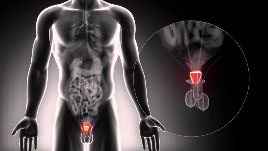 DIAGNOSIS WITH PROSTATE CANCER