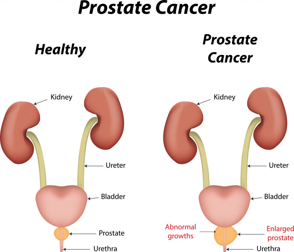 Prostate Cancer